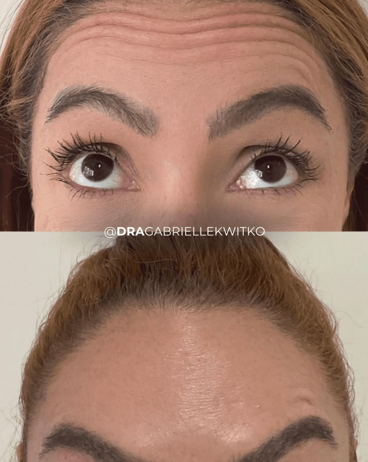 Antes e depois de toxina botulínica na testa