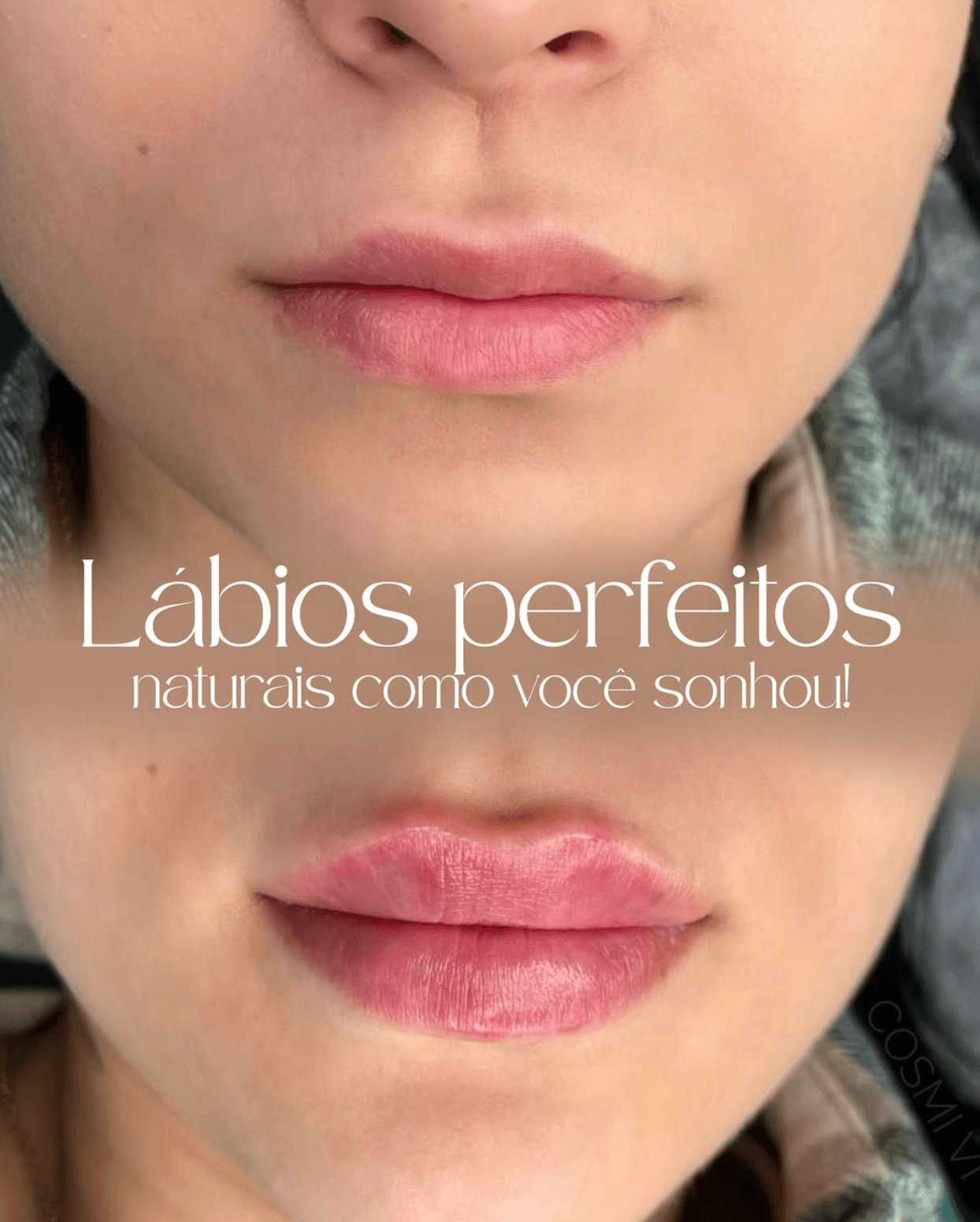 Antes e depois de preenchimento labial