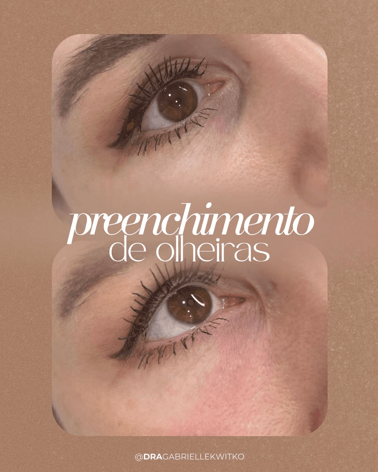 Antes e depois de preenchimento de olheiras