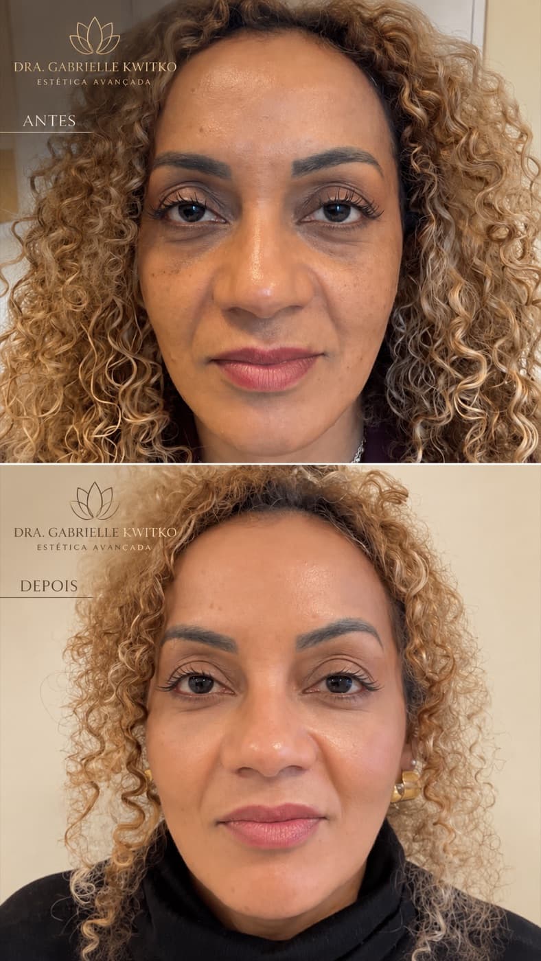 Antes e depois de preenchimento de olheiras com ácido hialurônico, paciente da Dra. Gabrielle em Florianópolis