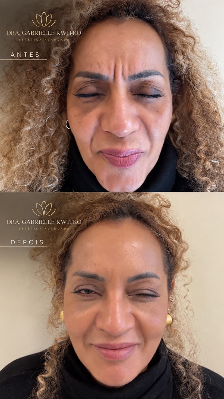 Antes e depois de toxina botulínica para linhas de expressão na testa e ao redor dos olhos, em Florianópolis