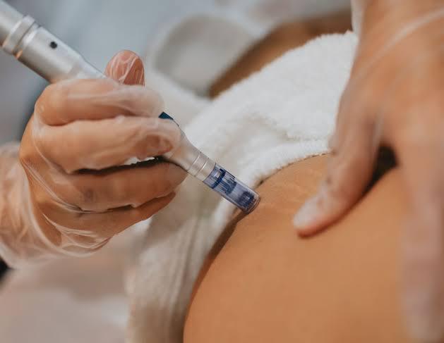 Preenchimento facial avançado na GK Estética Florianópolis - Santa Catarina: Realce de lábios, olheiras, maçãs do rosto e sulcos nasogenianos com técnicas avançadas e resultados duradouros