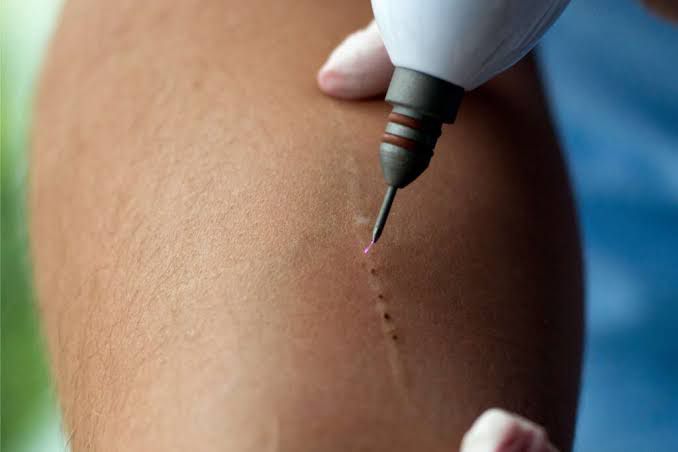 Preenchimento facial avançado na GK Estética Florianópolis - Santa Catarina: Realce de lábios, olheiras, maçãs do rosto e sulcos nasogenianos com técnicas avançadas e resultados duradouros