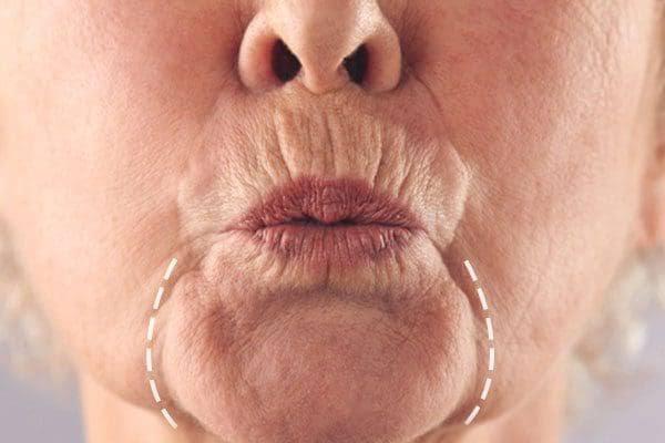 Preenchimento glúteo com ácido hialurônico na GK Estética: Técnica inovadora para realçar e remodelar contornos dos glúteos, com resultados duradouros e personalizados